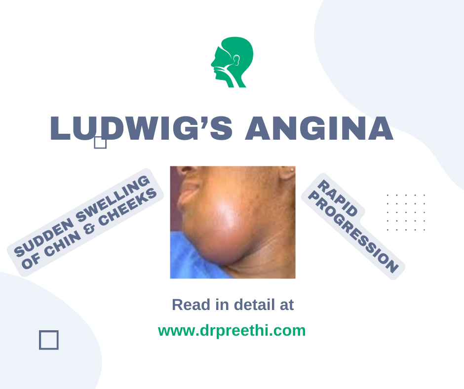Ludwigs Ludwig’s Angina: A Serious Infection Requiring Prompt Attention – Dr ...